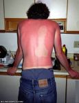 Penis_Sunburn